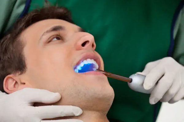 Blue light curing on dental bonding