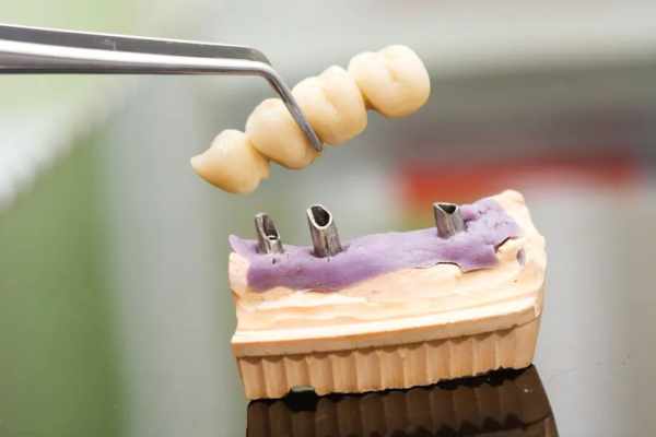 Implant Dental Partial being seated