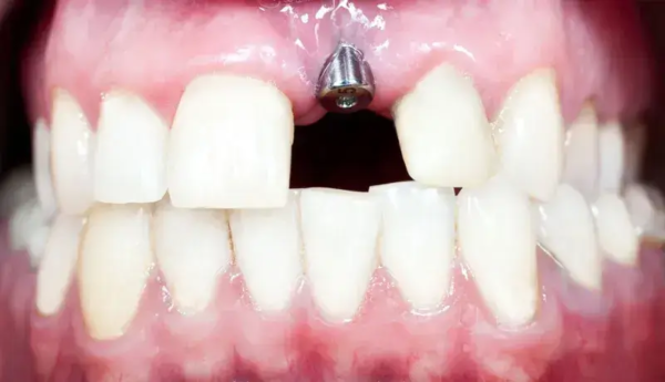 Implant base for front left tooth