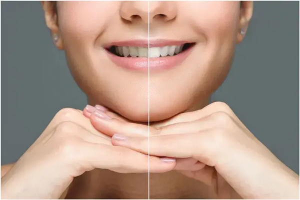 Side by Side color comparison of teeth whitening