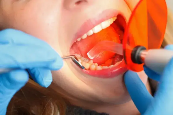 Using Natural colored fillings to restore tooth