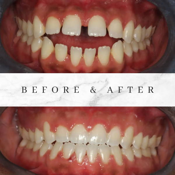 before and after fast braces case