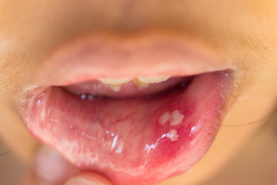 All about Canker Sores inside lip