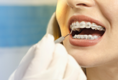 Braces & Oral Hygiene Dentist cleaning braces