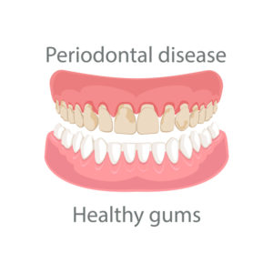 Causes & Effect of Gum Disease Healthy vs gum disease