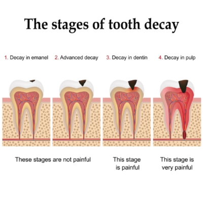Diagnosis & Management of Cavities stages of decay