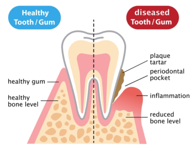Bleeding Gums healthy vs diseased tooth