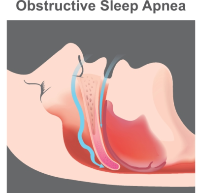 What to know about sleep apnea? Diagram