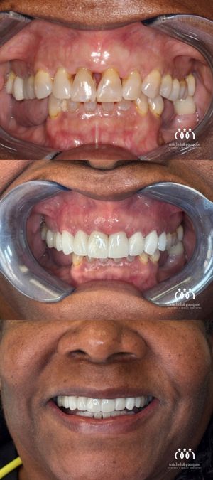 Before and after dental restoration for Greenville, NC patient.