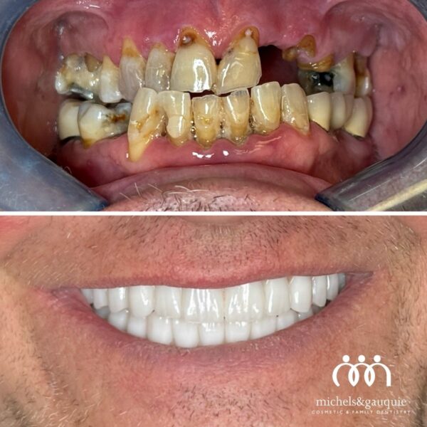 Full arch dental implants before and after Greenville NC severe tooth decay restored smile