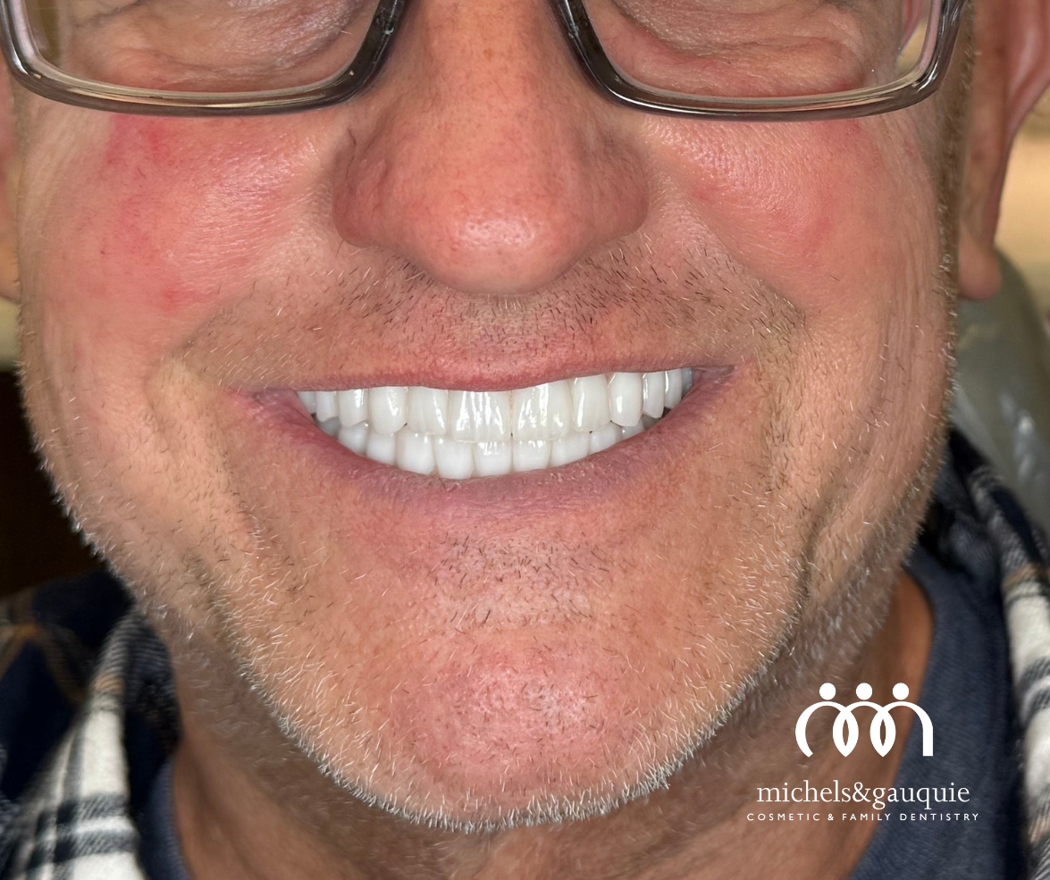 Dental implants smile makeover after result in Greenville NC by Michels & Gauquie