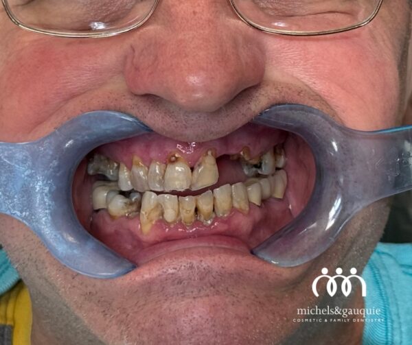 Dental implants before image showing damaged and missing teeth in Greenville NC