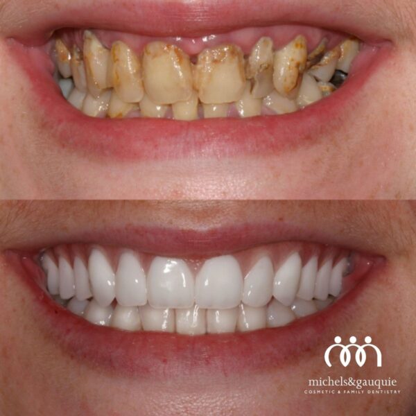 before and after full smile restoration Greenville NC using dental implants and cosmetic crowns