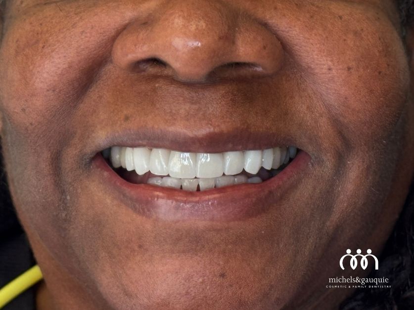 Close-up of smile after cosmetic dental restoration in Greenville NC