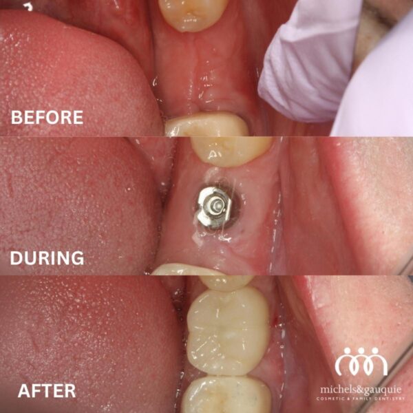 before during after single tooth dental implant process Greenville NC showing implant placement and final crown