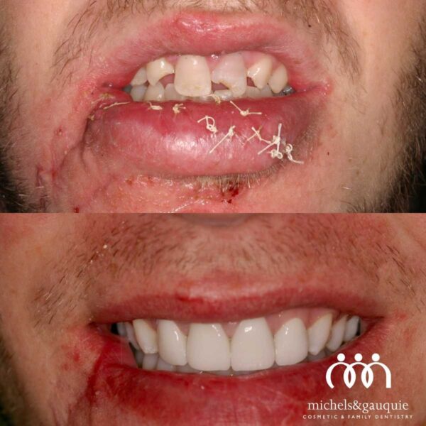 Emergency dental trauma repair before and after in Greenville NC showing severe injury restoration