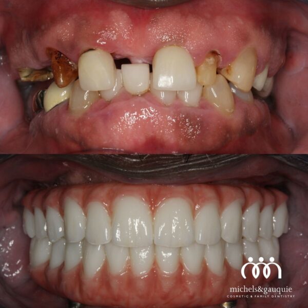 Dental implant recovery timeline results in Greenville NC showing before and after full mouth restoration