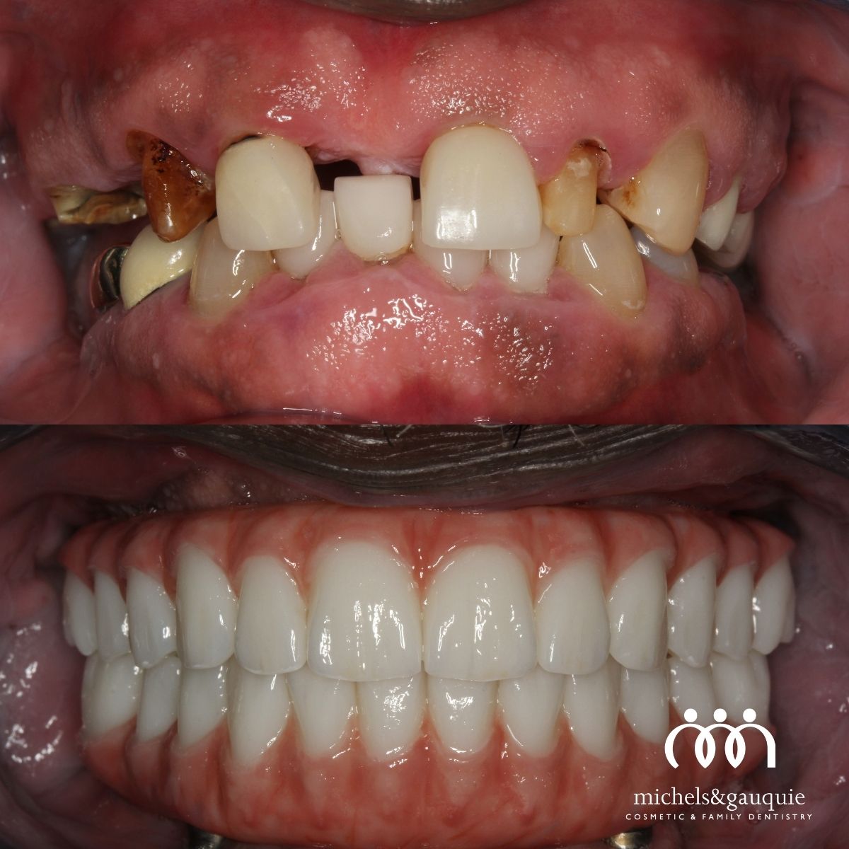 Dental implant recovery timeline results in Greenville NC showing before and after full mouth restoration