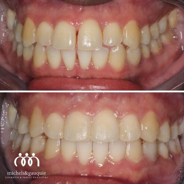 Fastbraces before and after results showing teeth alignment improvement in Greenville NC