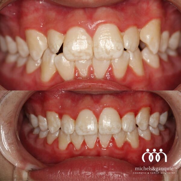 Fastbraces treatment improving crowded teeth alignment as part of cosmetic dentistry in Greenville NC