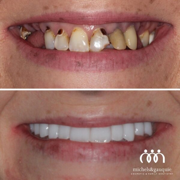 Full arch dental implants before and after in Greenville NC showing complete smile restoration