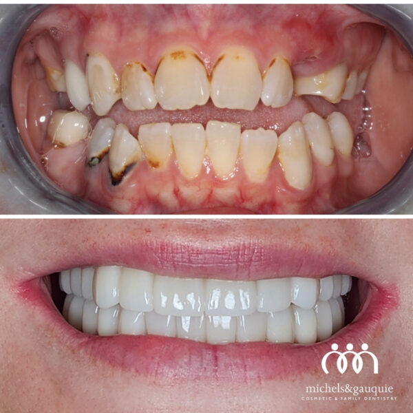 Full mouth dental implants before and after in Greenville NC