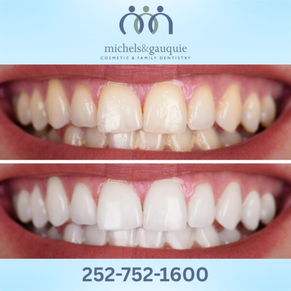 Professional teeth whitening before and after in Greenville NC showing brighter smile results
