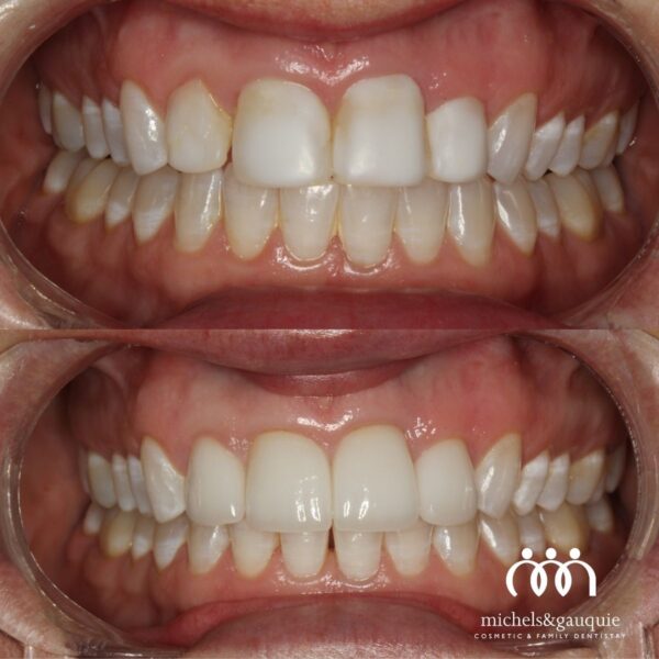 Before and after cosmetic bonding treatment by Dr. Chris Gauquie showing improved tooth shape, symmetry, and smile appearance.
