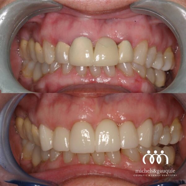 Before and after dental crown replacement on front teeth in Greenville NC