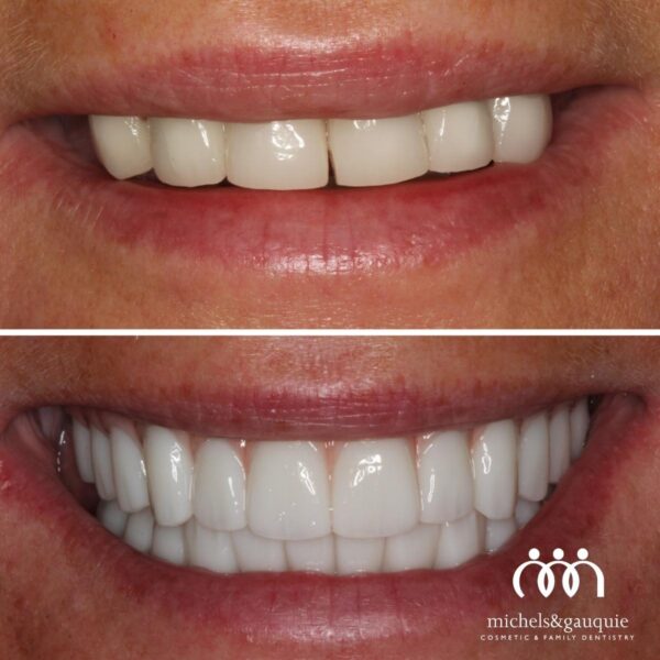 Before and after full mouth dental implant restoration showing long-lasting smile transformation by Michels & Gauquie in Greenville