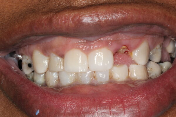 Patient with a knocked-out front tooth requiring emergency dental treatment in Greenville NC