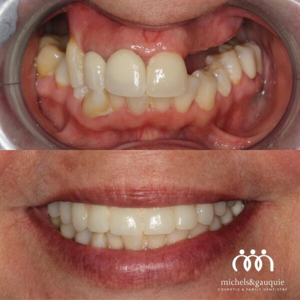 Smile design before and after treatment by Dr. Chris Gauquie showing a dramatic transformation in smile appearance, tooth position, and overall aesthetics.