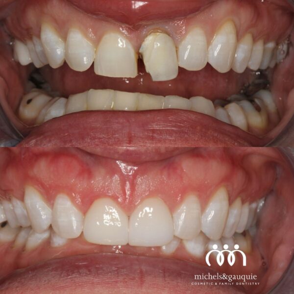 Before and after porcelain crown restoring a broken front tooth in Greenville NC