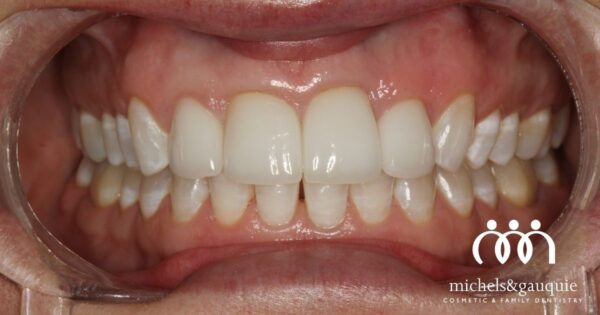 Before and after gum reshaping treatment showing a more balanced gum line and improved smile at Michels & Gauquie Cosmetic & Family Dentistry in Greenville, NC.