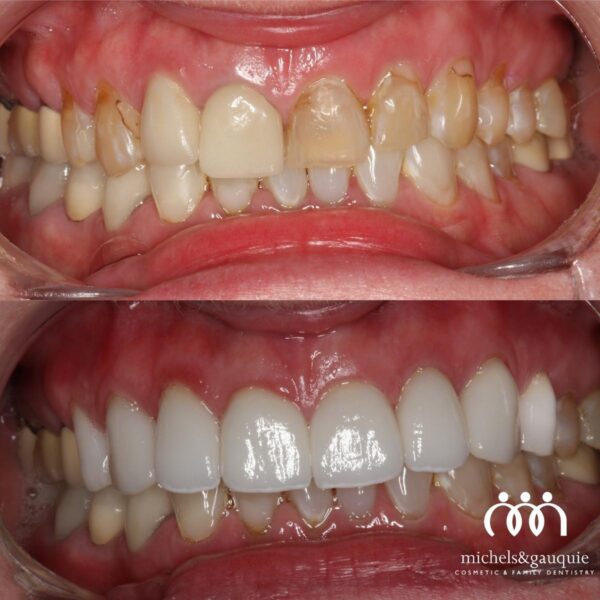 Before and after full mouth rejuvenation restoring worn and damaged teeth with cosmetic dentistry in Greenville NC